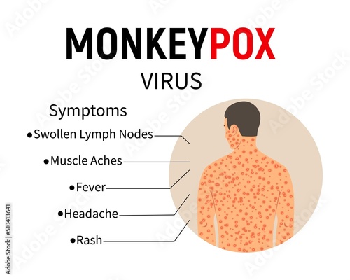 Symptoms of monkeypox. Disease infographic. Text and man with rash and ulcers on the body. Symptoms of the disease - swollen lymph nodes, muscle pain, fever, headache, rash. Vector.