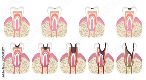Stages of caries development. Tooth structure in flat style. Tooth decay with enamel. Dental disease caries, pulpitis and periodontitis, realistic vector illustration