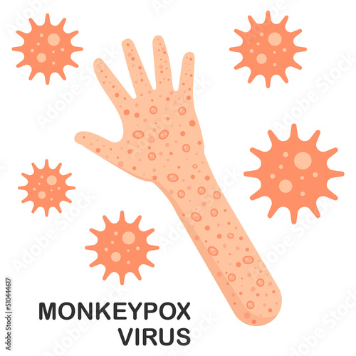 Monkeypox virus on hand and arm. Monkeypox Virus Outbreak as a contagious infection as blisters and leisons. Vector illustration.
