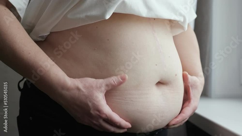 Overweight aged woman checks fat on belly. Woman compresses skin on abdomen checking for cellulite stretch marks and excess subcutaneous fat closeup photo