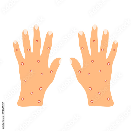 Monkeypox symptoms, hand skin rashes, blisters and purulent formations. Skin disease caused by a virus, chicken pox, acne, pustule in flat style isolated on white background