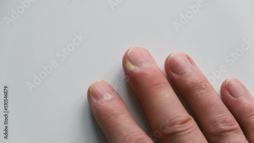 Swollen finger on a white background. The distal phalanx of the finger exhibits swelling due to acute paronychia. An infection of the cuticle photo