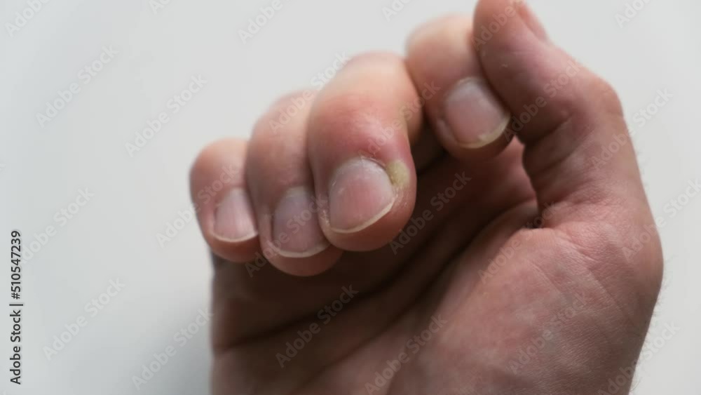 Swollen finger on a white background. The distal phalanx of the finger