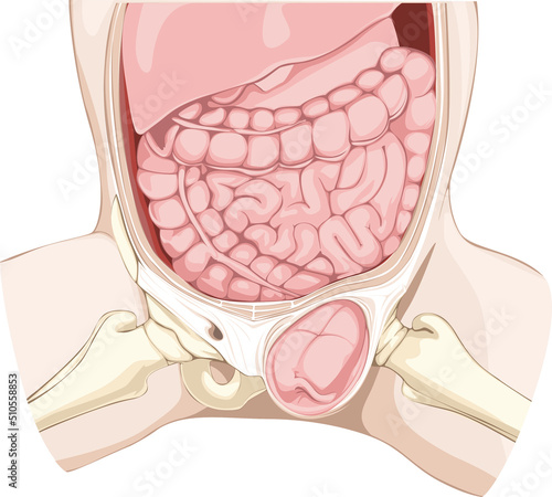 Hernia Illustration photo