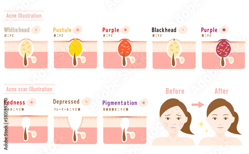 ニキビとニキビ跡 皮膚断面図 女性のビフォーアフター