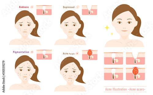 にきび跡とニキビ 皮膚断面図付き 女性の顔イラスト