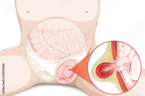 Hernia Illustration
