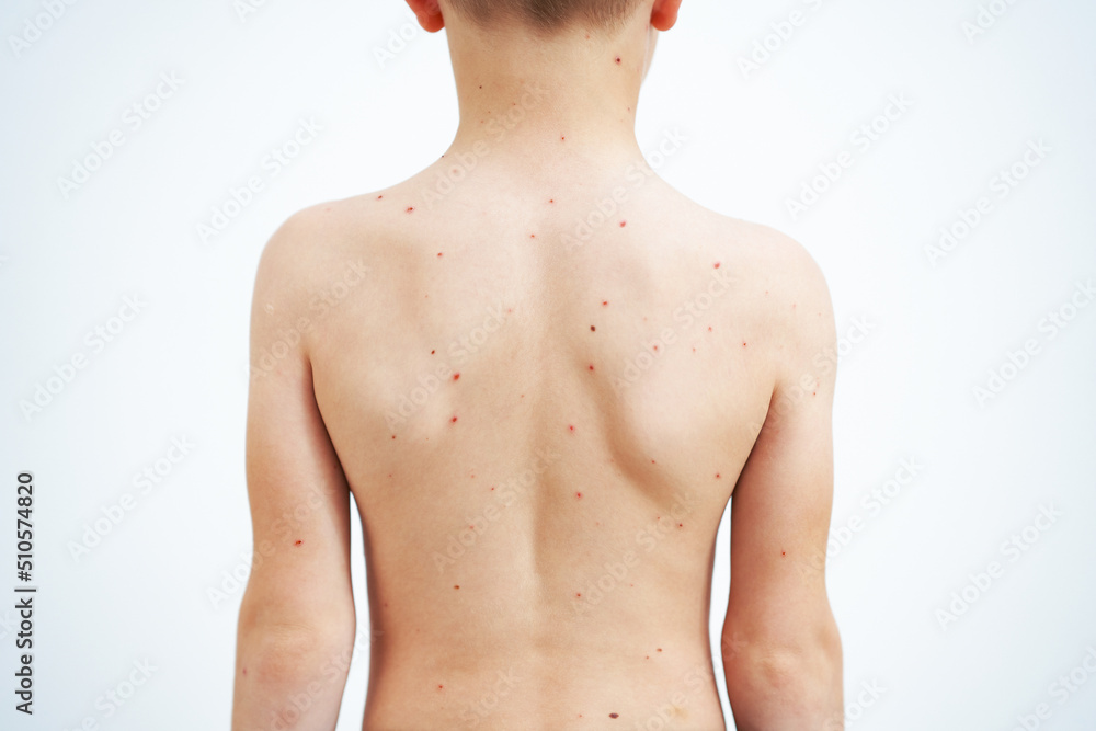 Young boy having chickenpox pictures of skin Young boy having chickenpox pictures of skin