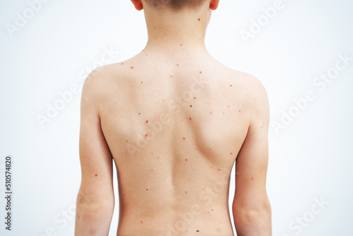 Young boy having chickenpox pictures of skin