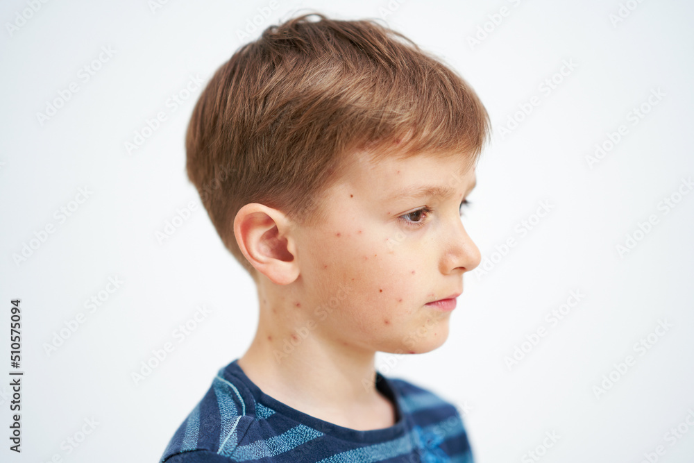 Young boy having chickenpox pictures of skin Young boy having chickenpox pictures of skin