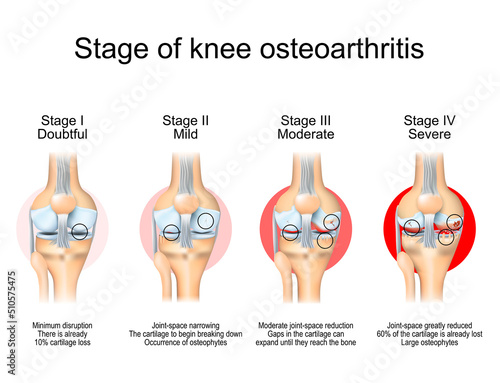 Stages of knee osteoarthritis photo