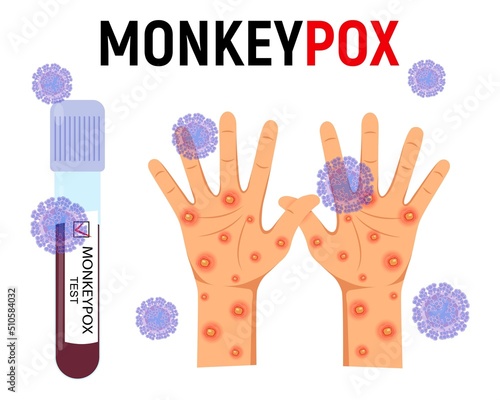 Monkey pox background. A test tube with blood for a test and a human hand with a rash and ulcers surrounded by viral cells on a white background. Disease symptoms. Vector illustration.