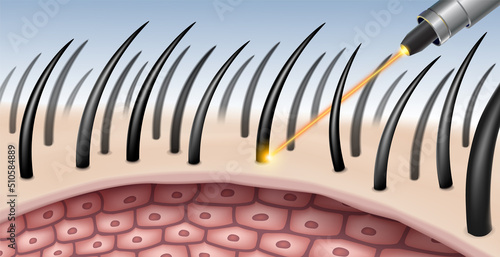Laser hair removal procedure for beauty Removes hair at the cellular deep level. Realistic file.
