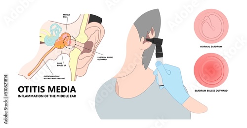 Acute Otitis Media air filled space eardrum treat pain fluid tube pus bacteria virus nasal cold flu drain swollen mastoid prevent diagnostic exam canal tool ENT Nose otalgia vertigo BPPV head wax test
