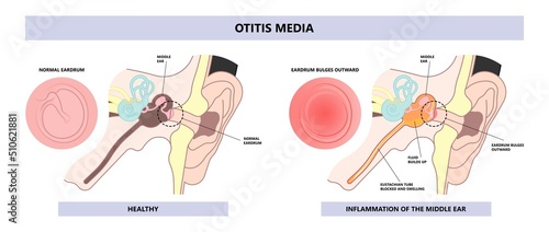 Acute Otitis Media air filled space eardrum treat pain fluid tube pus bacteria virus nasal cold flu drain swollen mastoid prevent diagnostic exam canal tool ENT Nose otalgia vertigo BPPV head wax test