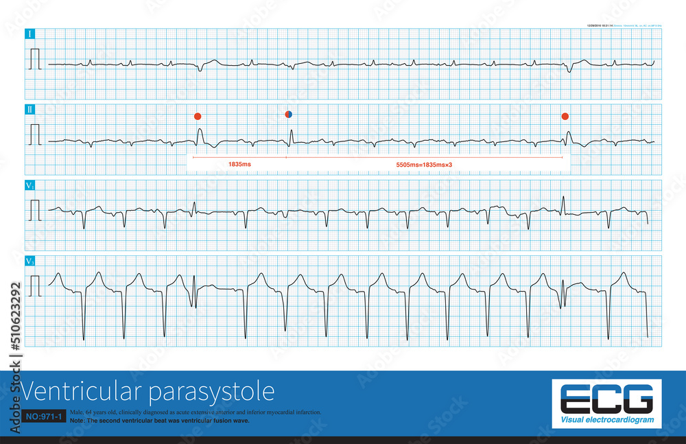 One patient with acute myocardial infarction had three ventricular ...