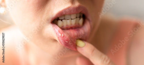 Close - up on the lip with aphthous stomatitis photo
