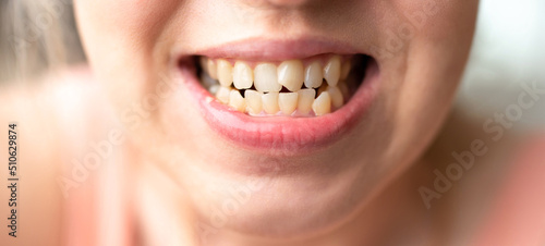 Close up of young woman\'s face with crooked teeth. Teeth before install braces. Teeth need ortodonti