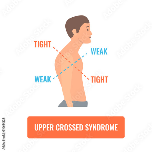 Upper crossed syndrome medical diagram. Crooked man with muscle strength imbalance. Weak and overactive muscles therapy. Incorrect spine curvature caused by bad posture. Vector illustration.