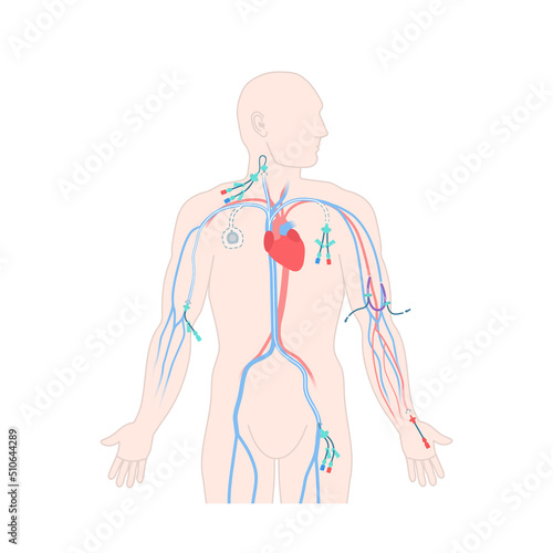 Central venous catheter placement sites shown on the male body. Types of central lines. Man with CVC access devices. PICC, arterial line, implantable port for infusion. Medical vector illustration.