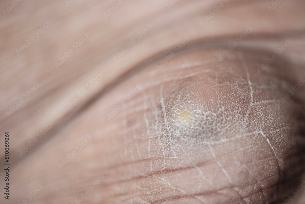 Fototapeta premium scars on the skin of a person's body