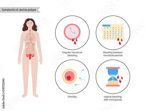 Uterus Polyps Disease