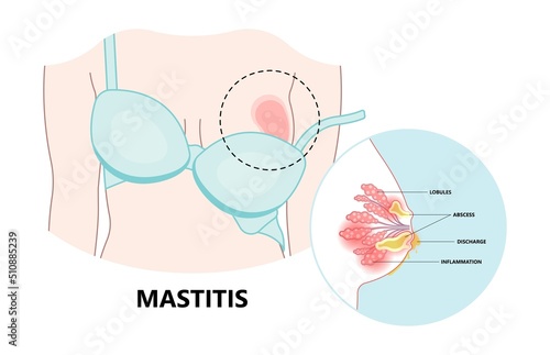 Pregnancy lymph nodes pus lump pain swelling baby newborn pump care sore gland cyst skin tumor lactational