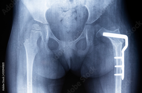 Osteotomy of the hip joint. Film radiograph of the pelvis shows dysplasia of the left thigh, metal plate. photo
