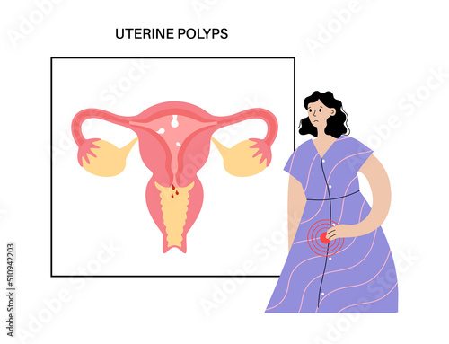 Uterus Polyps Disease