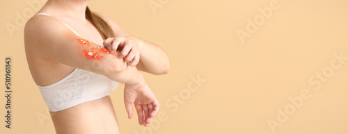 Fotografie Woman ill with monkeypox on beige background with space for text