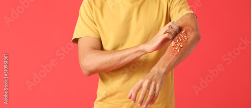 Man ill with monkeypox scratching his arm on red background photo