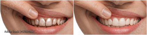 Collage with photos of young woman before and after dental treatment, closeup. Banner design