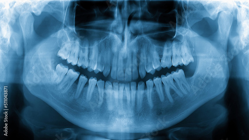 X-ray radiograph picture showing human jaw and teeth