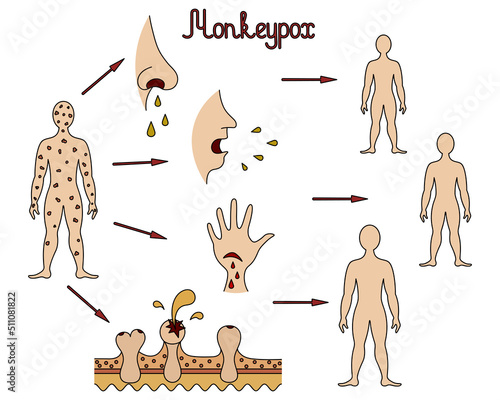 The mechanism of transmission of monkeypox. Diagram of human-to-human transmission of the smallpox virus. Color vector illustration. Transmission through body fluids, skin injury