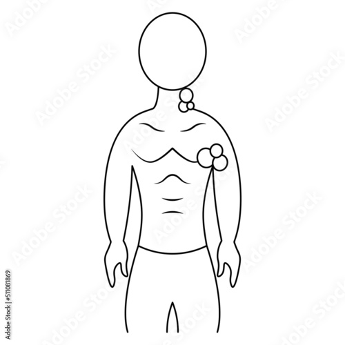 Enlarged lymph nodes. Sketch. Vector illustration. The patient has inflamed lymph nodes in the neck and armpits. A symptom of a disorder in the body. Outline on isolated background. Doodle style. 