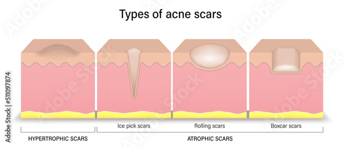 Types of acne scars. Facial skin problems. Hypertrophic scars and Atrophic scars. Vector for advertising about beauty and medical treatment. photo