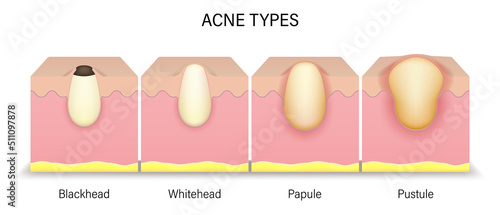Acne types. Human skin acne. Blackhead, Whitehead, Papule and Pustule. Vector for advertising about beauty and medical treatment.