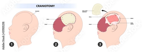 surgical to repair the skull bone with the metal mesh the procedure in medical photo