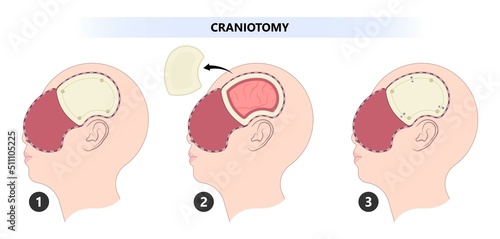 Brain cancer tumor and burr hole skull bone flap fluid head post sport accident cysts deep  stimulation Parkinson's confusion
