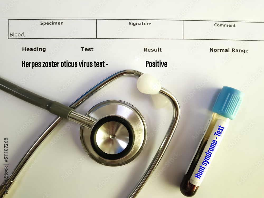 Fotka „Ramsay Hunt syndrome blood sample test at medical laboratory