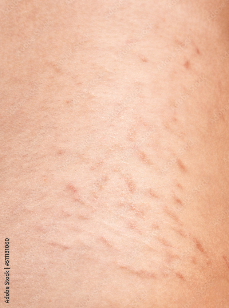 Skin with stretch marks on a woman's body close-up.Treatment of skin stretch marks in the clinic.