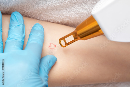 The doctor makes the procedure for laser tattoo removal on the girl's arm.