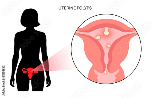 Uterus Polyps Disease