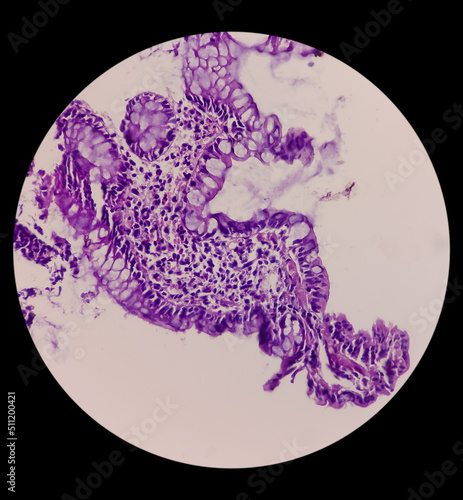 Terminal ileum(biopsy): Chronic nonspecific ileitis or inflammation of ileum, show ileal mucosa, lymphocytes,histiocytes,plasma cell, caused by Crohn's disease, inflammatory bowel disease (IBD). photo