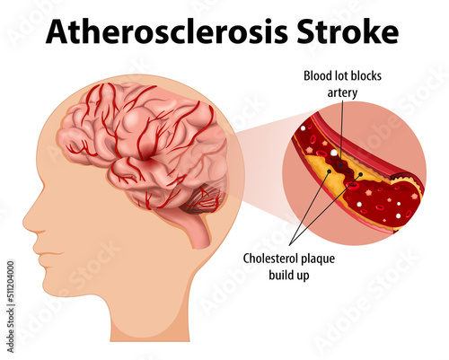 Human anatomy with atherosclerosis stroke
