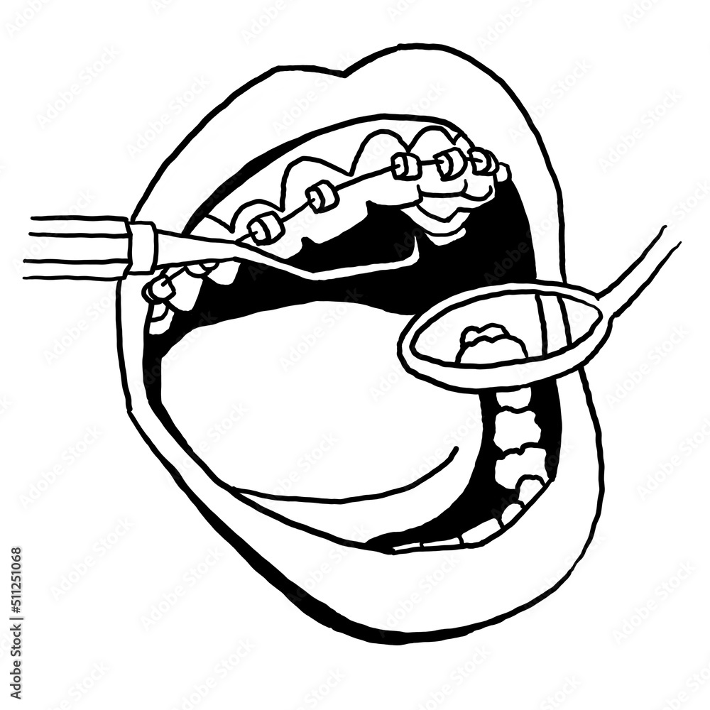 Braces on the teeth. Medical dentist checkup in dental clinic. Tooth correction with brackets. Open mouth showing healthy teeth and gums. Hand drawn retro vintage illustration. Old style drawing. Braces on the teeth. Medical dentist checkup in dental clinic. Tooth correction with brackets. Open mouth showing healthy teeth and gums. Hand drawn retro vintage illustration. Old style drawing.