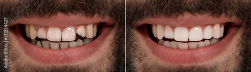 Foto Collage with photos of young man before and after dental treatment, closeup