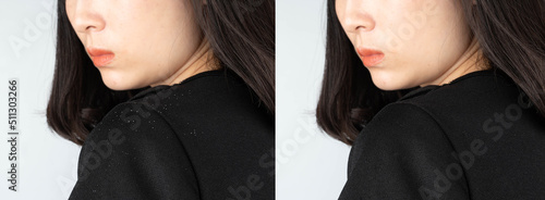 Before and after treatment dandruff and seborrheic dermatitis. Long black hair woman looking at hair flakes on her shoulder. Hair care concept.
