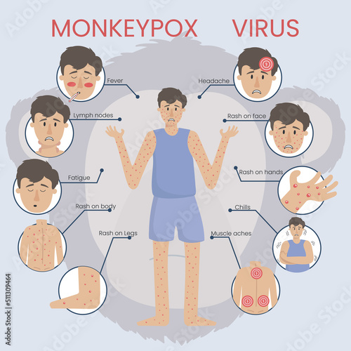 Infographic concept of monkeypox virus 2022. The man is sick with smallpox and symptoms of monkeypox