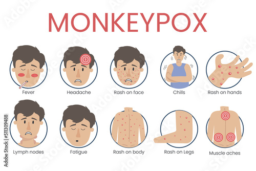 Monkey pox virus concept showing the symptoms of the disease: fever, headache, rash on the body.